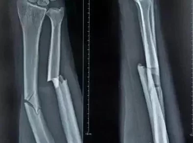 探索父亲康复之路：爸爸活下去的关键策略与痊愈条件全面指南